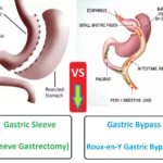 Gastric Sleeve Vs Gastric Bypass Surgery: Which is Safer & Effective? 32 gastric sleeve vs gastric bypass surgery