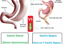 Gastric Sleeve Vs Gastric Bypass Surgery: Which is Safer & Effective? 12 gastric sleeve vs gastric bypass surgery