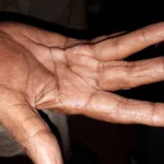 Dupuytren’s Contracture causes and treatment