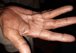 Dupuytren’s Contracture causes and treatment