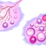 ozempic for pcos
