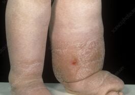 Lymphoedema of the legs physical therapy