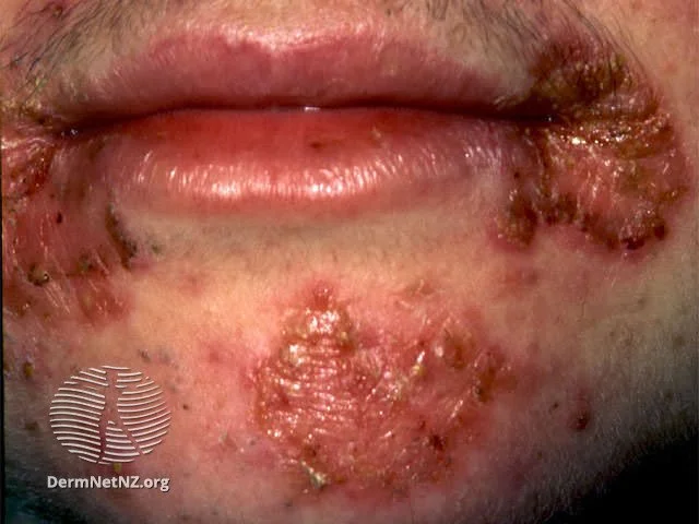 Diabetic Skin Lesions: Rash, Blisters, Dermopathy, & Ulcers 20 severe impetigo and herpes simplex infection in a diabetic skin lesions