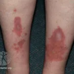 Diabetic Skin Lesions: Rash, Blisters, Dermopathy, & Ulcers 24 Necrobiosis Lipoidica diabeticorum diabetic skin lesions