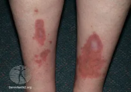 Necrobiosis Lipoidica diabeticorum diabetic skin lesions