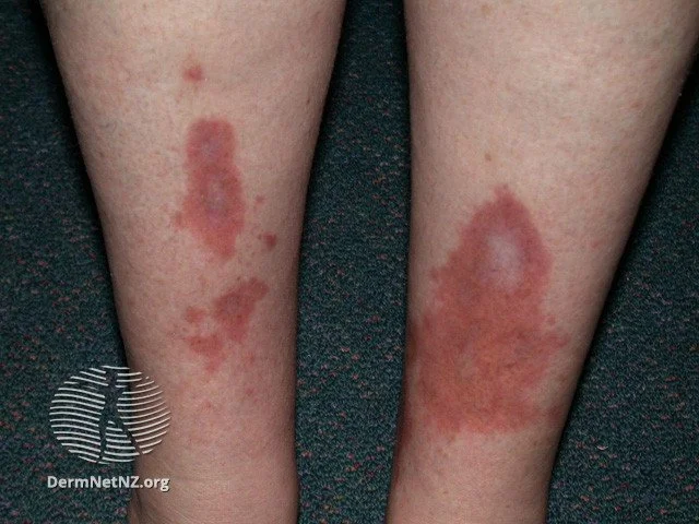 Diabetic Skin Lesions: Rash, Blisters, Dermopathy, & Ulcers 14 Necrobiosis Lipoidica diabeticorum diabetic skin lesions