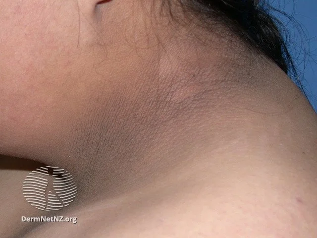 Diabetic Skin Lesions: Rash, Blisters, Dermopathy, & Ulcers 17 acanthosis nigricans