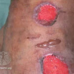 Diet for Psoriasis and Psoriatic Arthritis 17 diabetic foot ulcer bullous eruptions