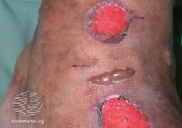 diabetic foot ulcer bullous eruptions