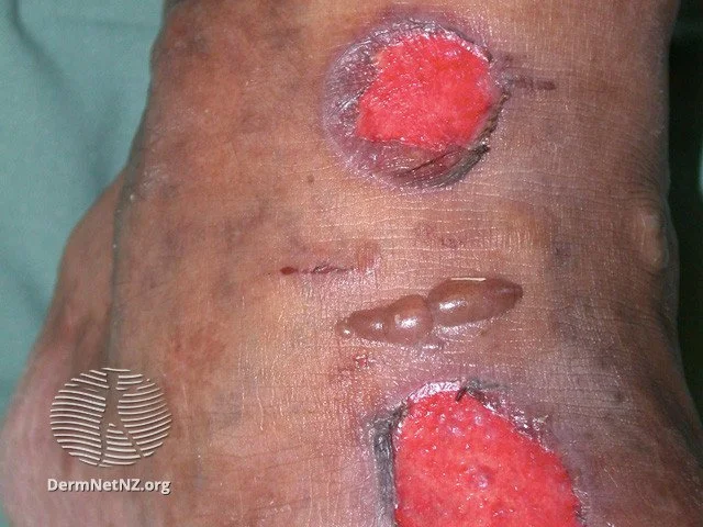 Diabetic Skin Lesions: Rash, Blisters, Dermopathy, & Ulcers 16 diabetic bullous eruptions diabetic skin lesions