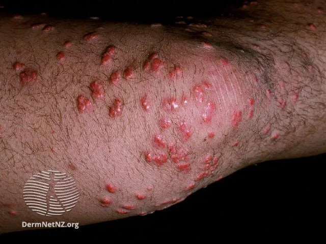 Diabetic Skin Lesions: Rash, Blisters, Dermopathy, & Ulcers 18 eruptive xanthomas in diabetics diabetic skin lesions