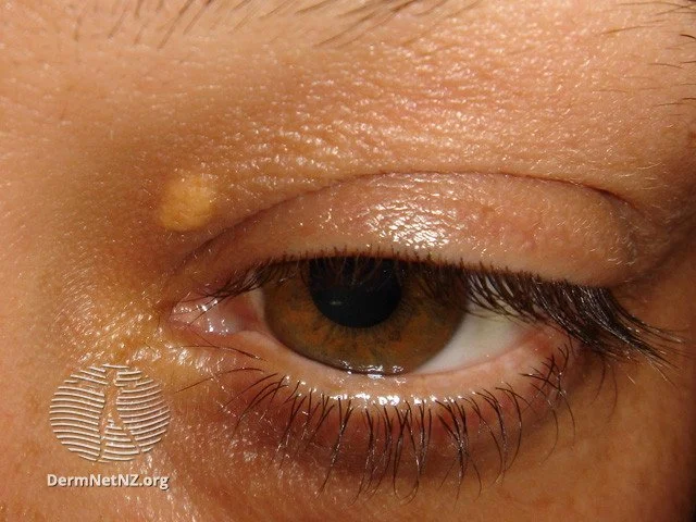 Diabetic Skin Lesions: Rash, Blisters, Dermopathy, & Ulcers 19 Xanthelasma is common in diabetic skin lesions