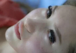 Acne on the face of a woman with PCOS