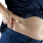 What does a PCOS belly look like