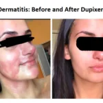 Diet for Psoriasis and Psoriatic Arthritis 13 Dupixent Side effects Red Face DFR before and after