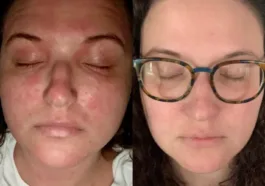 Facial eczema cleared with Dupixent use after 6 months does dupixent make you tired or is it your eczema
