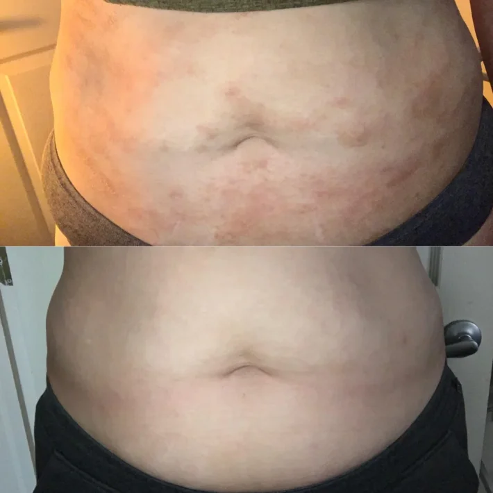 Dupixent Before and After Pictures: Dupilumab for Eczema 15 Tummy eczema cleared with Dupixent use