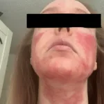 Dupixent Side effects Red Face: Dupilumab Facial Redness (DFR) 31 dupixent side effects facial redness dupilumab facial redness