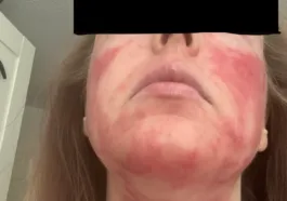 dupixent side effects facial redness dupilumab facial redness