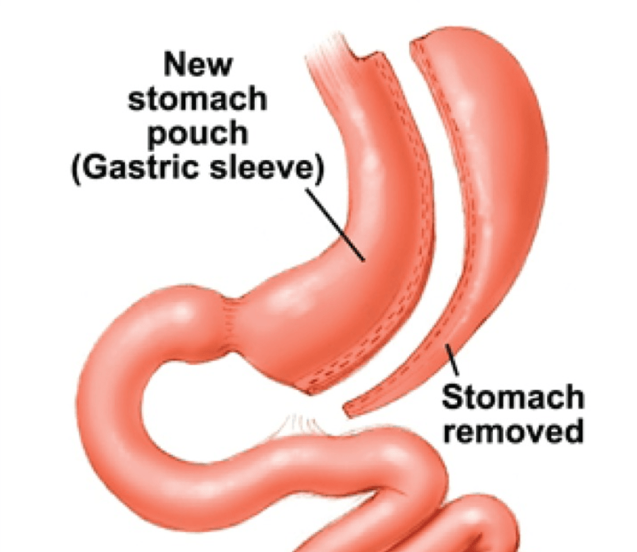 Laparoscopic sleeve gastrectomy