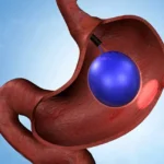 Gastric Sleeve Vs Balloon for Weight Loss and Diabetes 27 gastric sleeve vs balloon Complications of bariatric surgery Weight Loss Balloon gastric balloon weight loss balloon