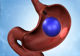 Exploring the Power of Weight Loss Balloon and Endoscopic Interventions 4 gastric sleeve vs balloon Complications of bariatric surgery Weight Loss Balloon gastric balloon weight loss balloon