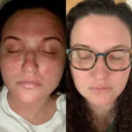 Dupixent Before and After Pictures: Dupilumab for Eczema 23 foods that help eczema go away