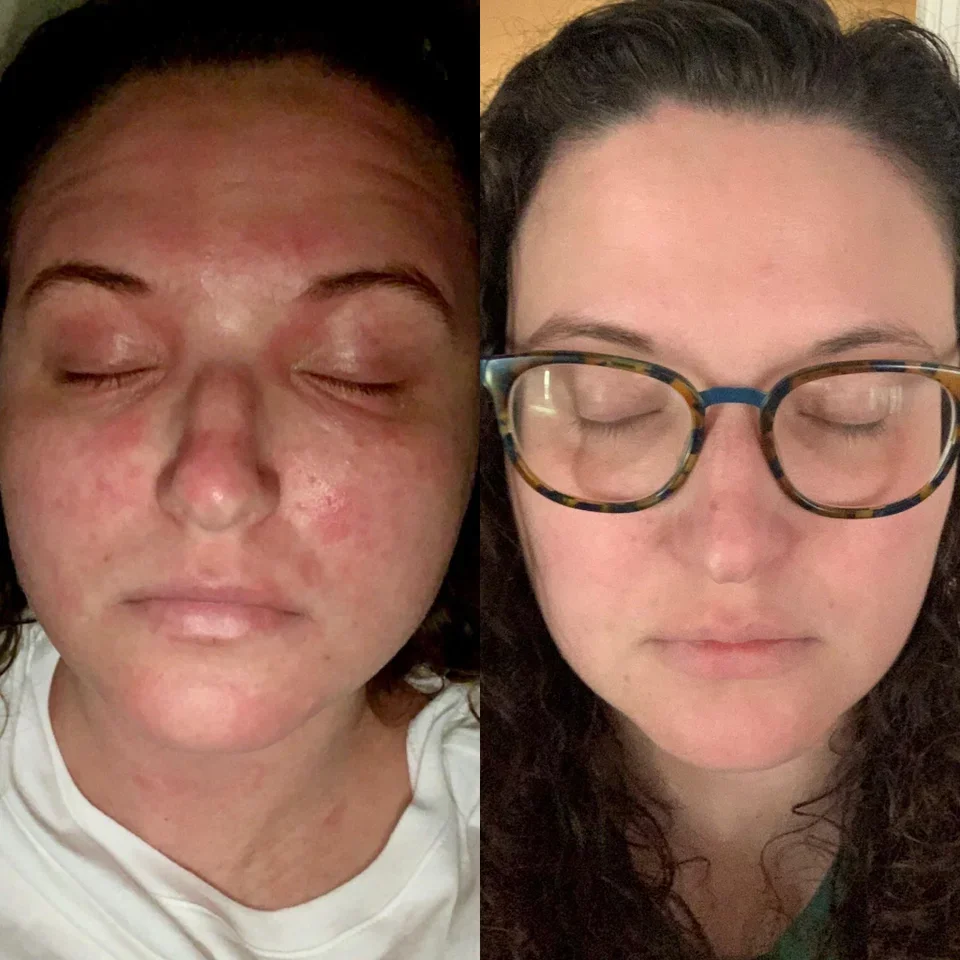 Dupixent Before And After Pictures Dupilumab For Eczema   Six Months On Dupixent 1.webp