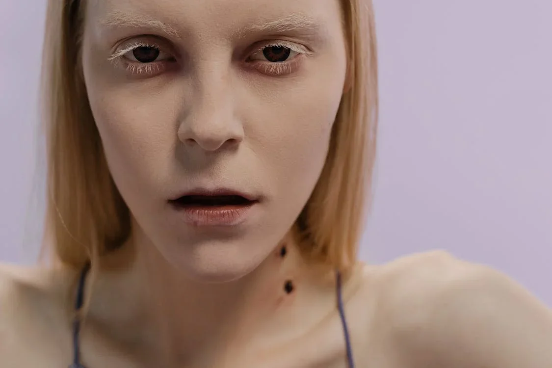 Ozempic face gaunted face