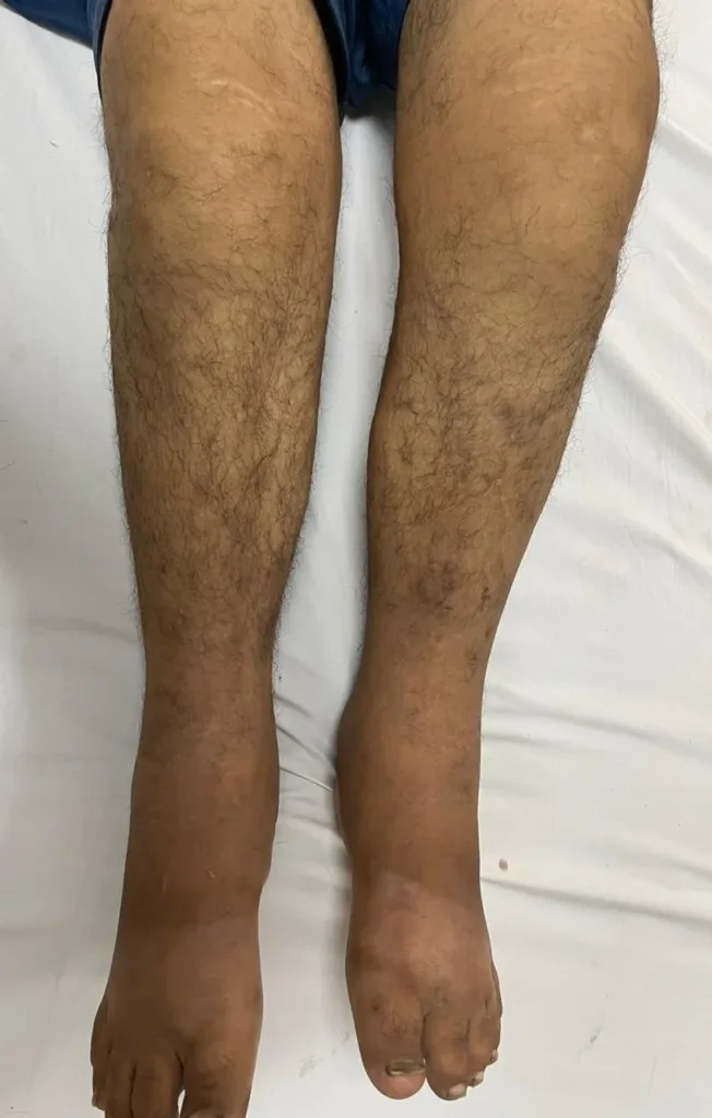 Stone Man Syndrome: A Man Whose Body Turned to Stone 15 swelling of both legs of a patient with stone man syndrome
