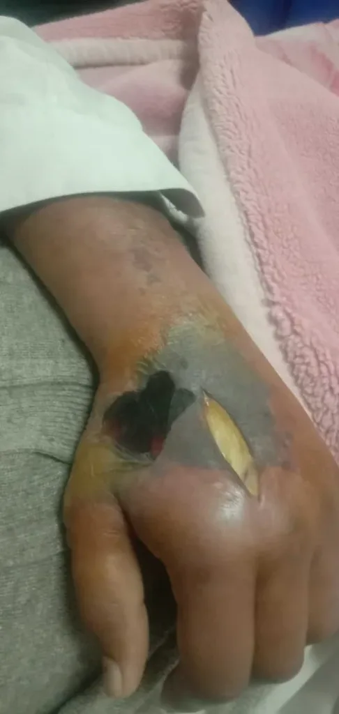 Recovering from Diabetic Hand Infection Post-Angioplasty 14 A cut was given to drain the pus diabetic hand infection