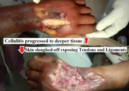 diabetic hand infection progressed