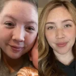 Mounjaro Face before and after pictures