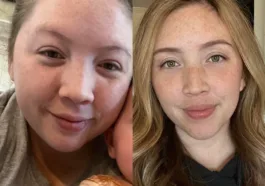 Mounjaro Face before and after pictures