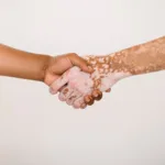 non segmental vitiligo Afamelanotide for vitiligo scenesse implant cream