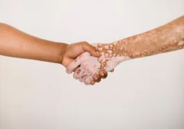 non segmental vitiligo Afamelanotide for vitiligo scenesse implant cream