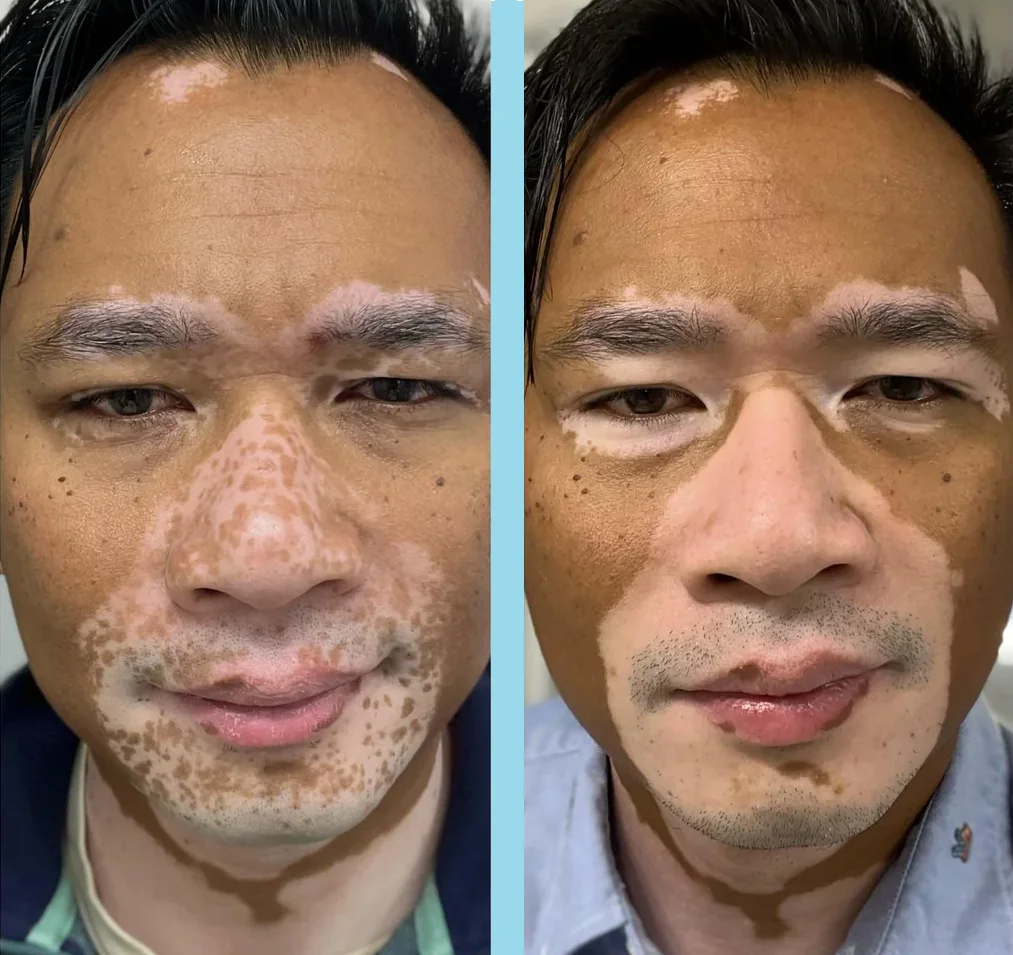 Opzelura 2 months progress before and after picture