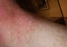 Redness bumps and burning of skin with opzelura cream use opzelura side effects