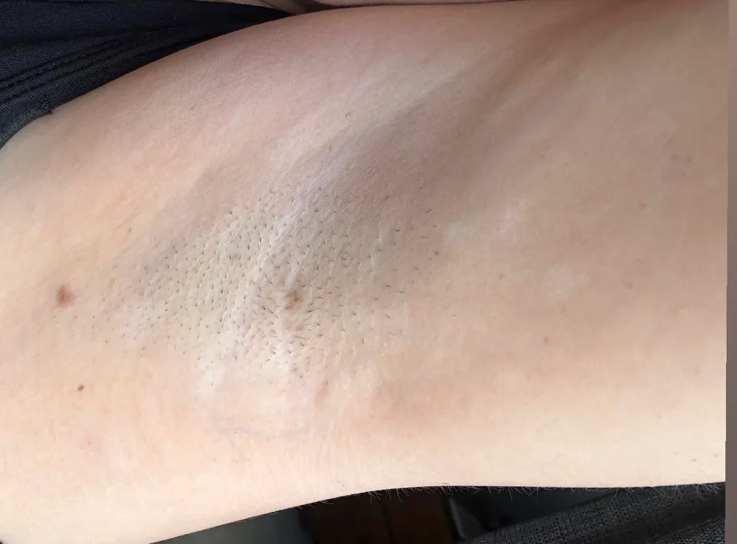 Vitiligo of armpit fading away with Opzelura cream after 3 months
