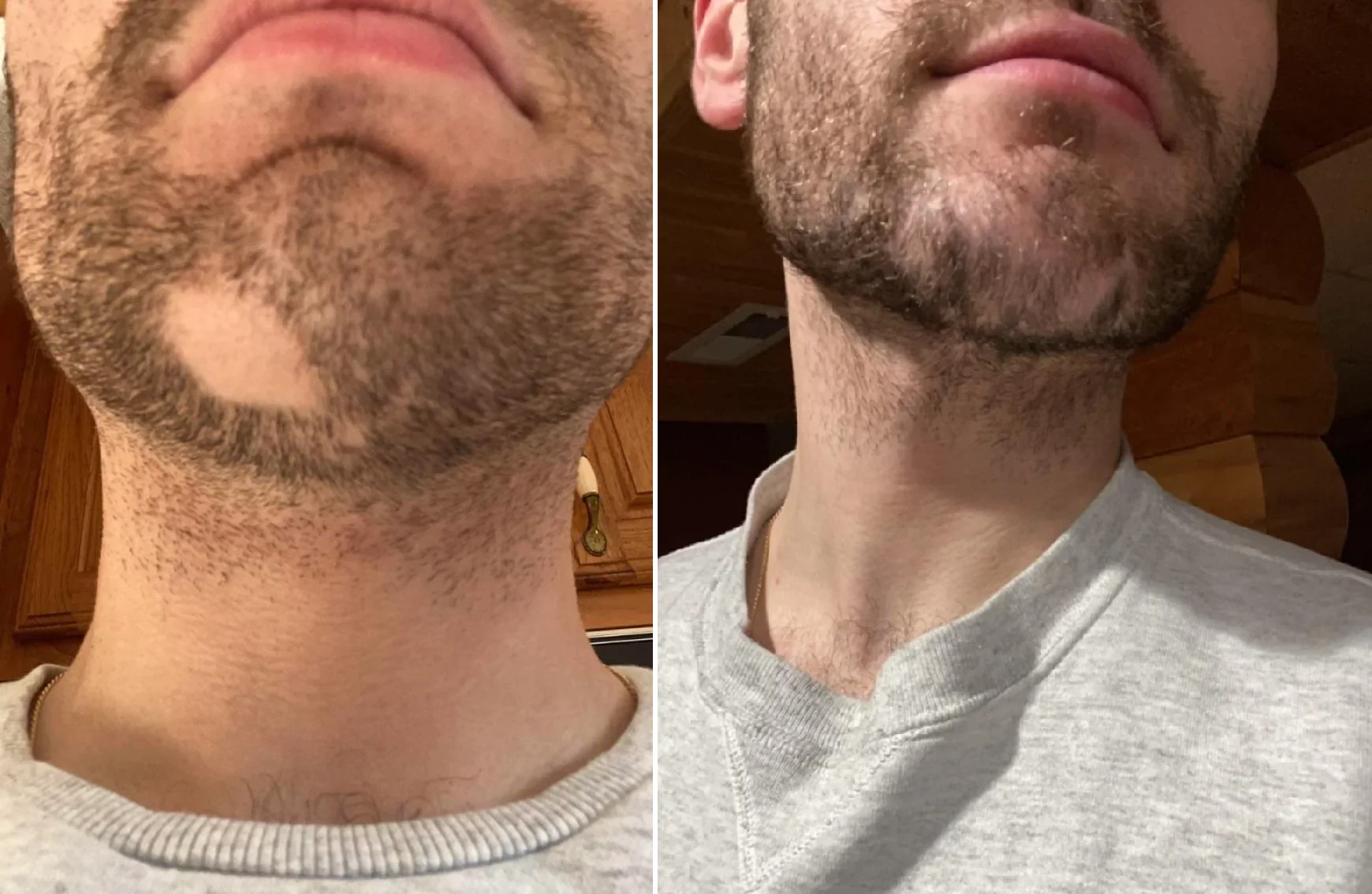 Vitiligo of chin before andafter picture using Opzelura cream