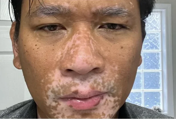 Vitiligo of face after applying Opzelura cream