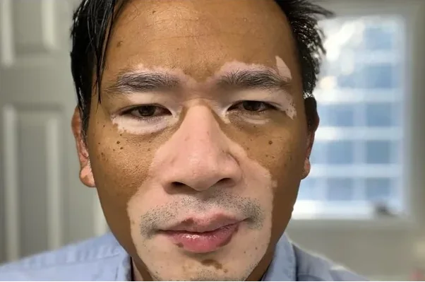 Vitiligo of face before Opzelura application