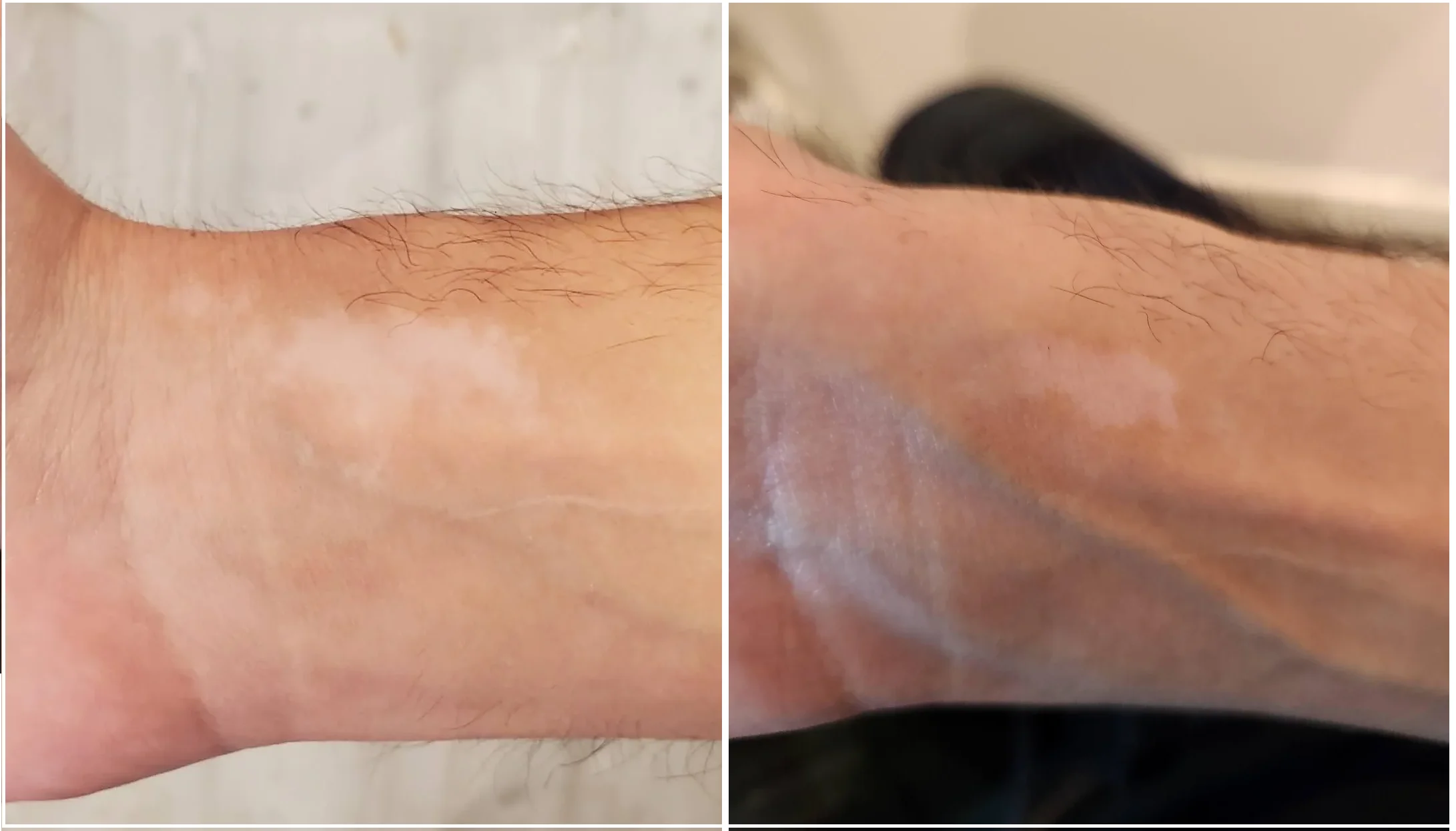 Vitiligo of wrist and forearm before pic