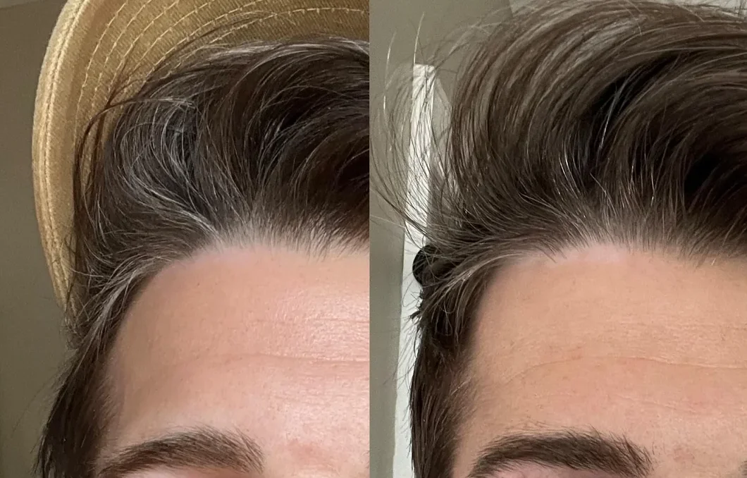 new spots along hairline after a month of Opzelura cream use