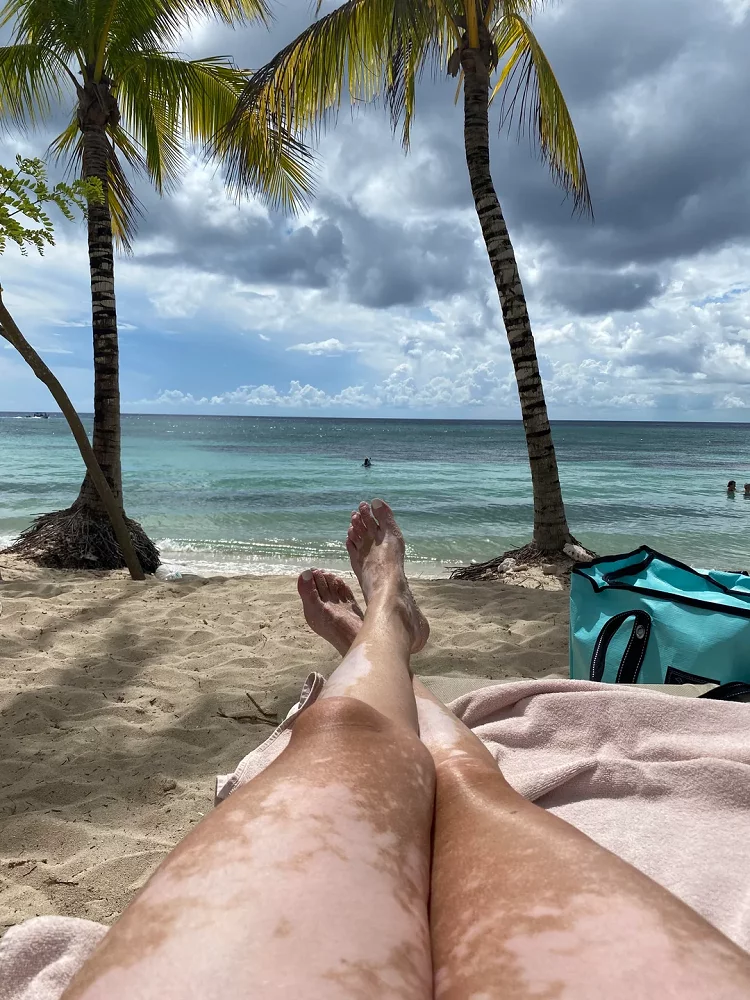 vitiligo of legs and thighs opzelura cream for vitiligo sunbathing