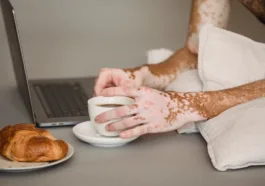 rinvoq for vitiligo upadicitinib for vitiligo vitiligo causes treatment