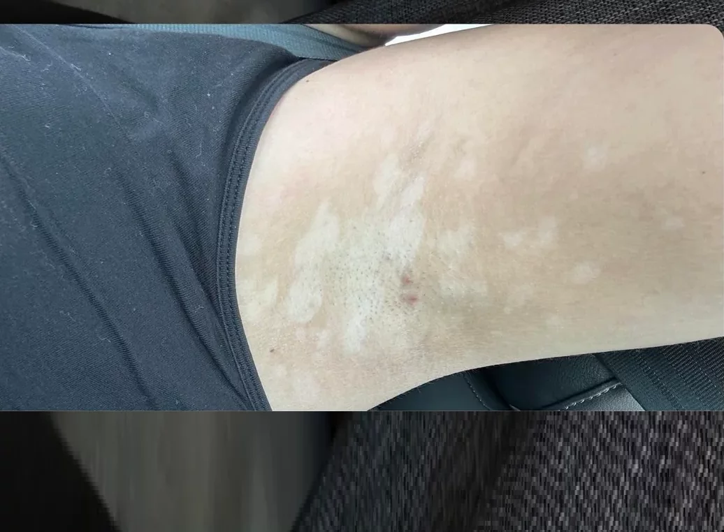vitiligo of armpits before Opzelura cream