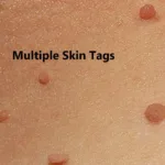 Skin Tags in Children: Could They Signal Health Risks? 25 skin tags in children