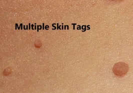 skin tags in children