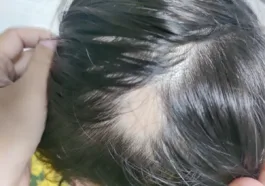 new treatment for alopecia areata new treatment for hair loss